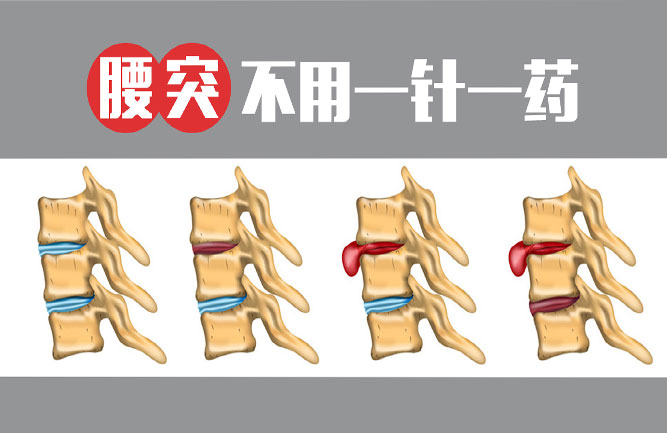 鐵腰板治療儀能治腰間盤突出嗎 鐵腰板治療儀能治腰間盤突出嗎