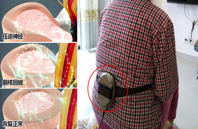 腰椎間盤突出最好的治療方法是什么 腰椎間盤突出最好的治療方法是什么