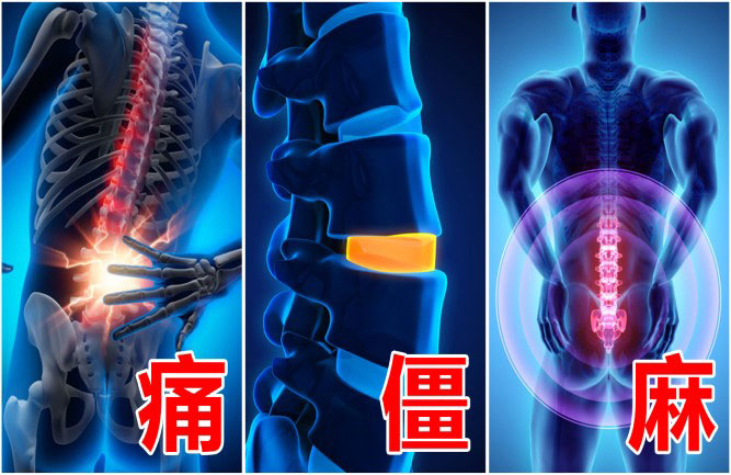 腰椎間盤突出最好的治療竟然有這么多種方 腰椎間盤突出最好的治療竟然有這么多種方法