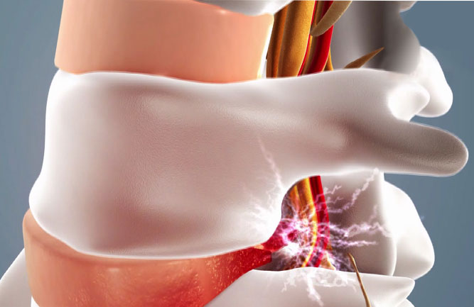 腰椎間盤突出治療最好方法 腰椎間盤突出治療最好方法