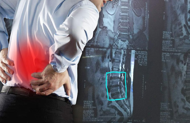 鐵腰板用它治療最好 鐵腰板用它治療最好